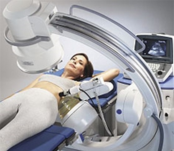 các phương pháp tán sỏi thận hiện nay như thế nào