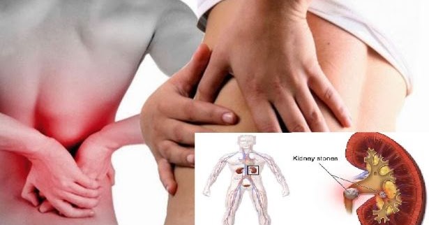 các phương pháp tán sỏi thận hiện nay như thế nào