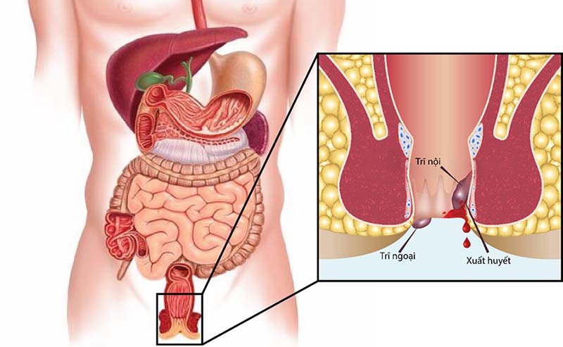 Cách chữa bệnh trĩ tại nhà hiệu quả an toàn