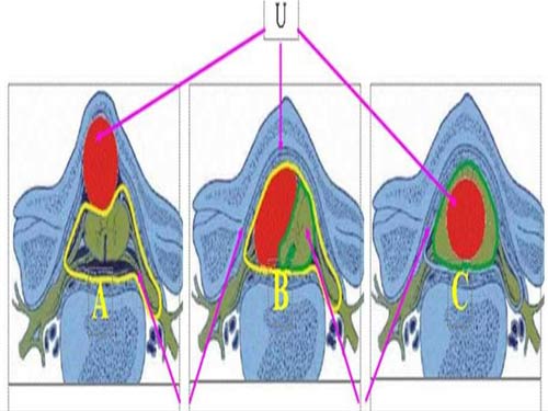 Cách chữa bệnh ung thư máu bằng thuốc nam hiệu quả