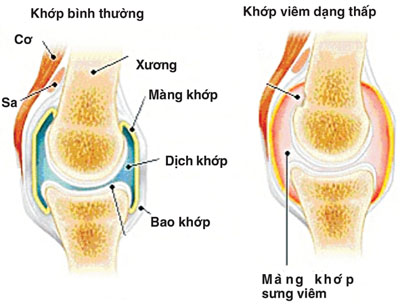 Viêm khớp dạng thấp