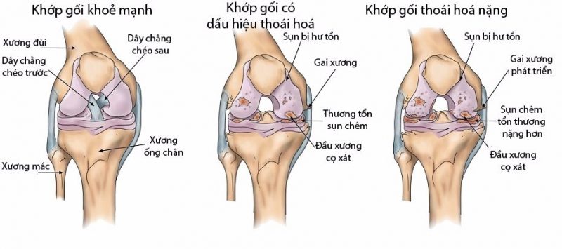 Cách chữa nhức mỏi chân hiệu quả