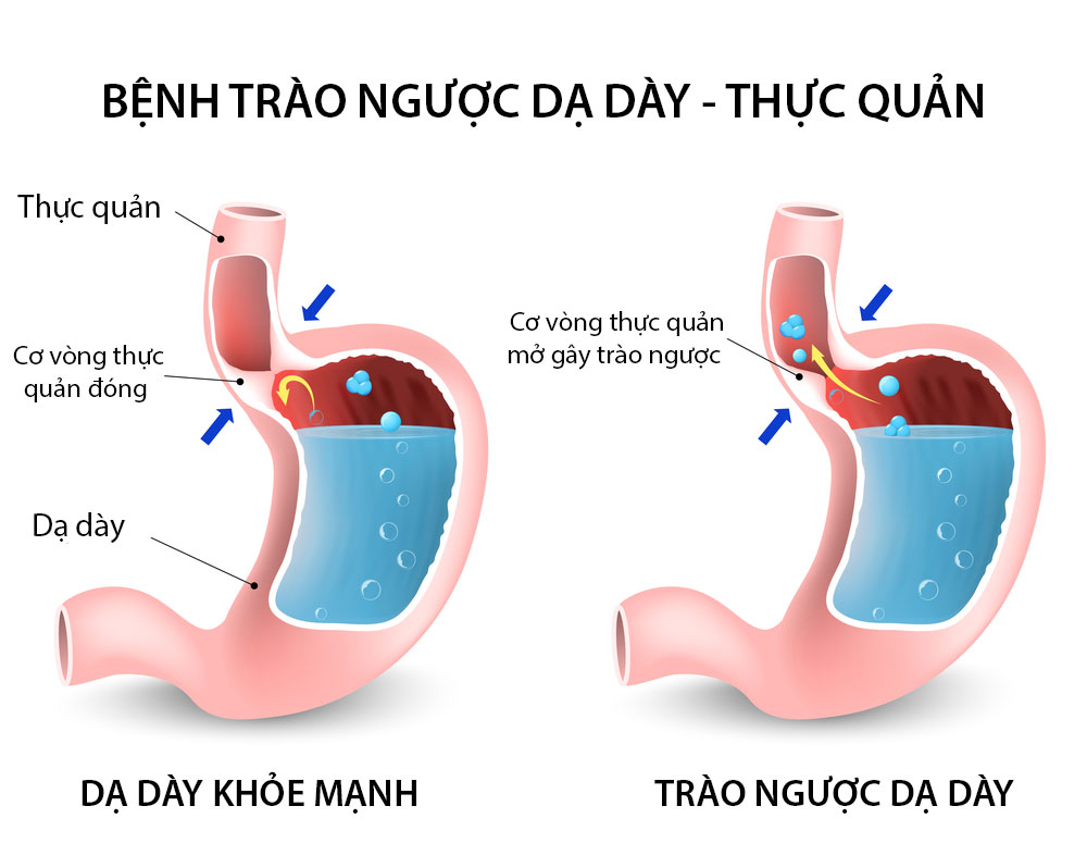 Cách chữa sỏi thận bằng màng mề gà an toàn hiệu quả