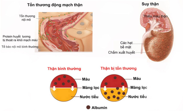 Cách chữa sỏi thận bằng quả sung an toàn hiệu quả