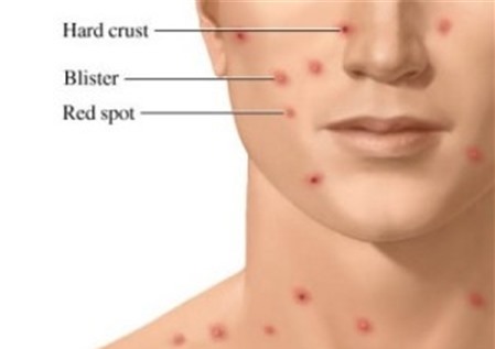 Cách chữa sỏi thận bằng rau diếp cá an toàn hiệu quả