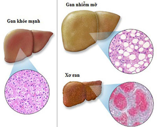 Cách chữa trị gan nhiễm mỡ độ 2 an toàn hiệu quả