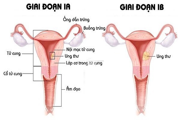Cách chữa ung thư cổ tử cung giai đoạn đầu an toàn hiệu quả