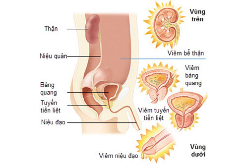 Cách chữa viêm đường tiết niệu ở nam giới như thế nào