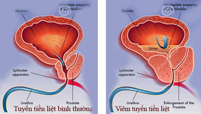 Cách chữa viêm tuyến tiền liệt mãn tính