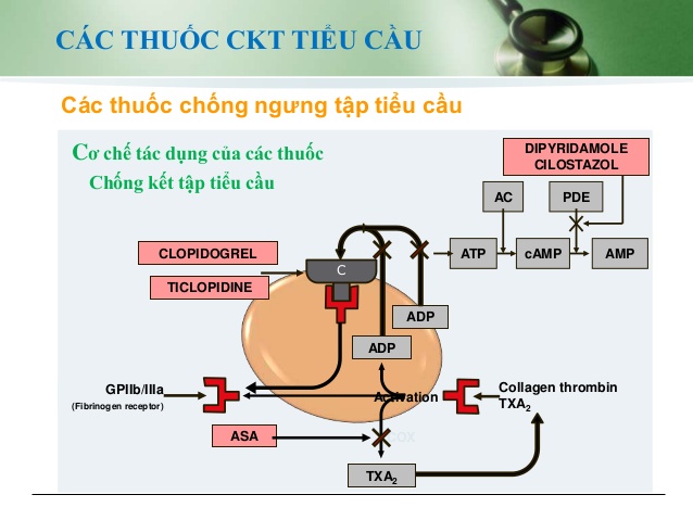 Cách điều trị bệnh tai biến mạch máu não an toàn hiệu quả