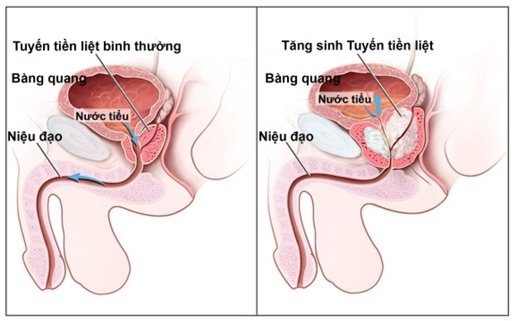 Cách điều trị phì đại tuyến tiền liệt như thế nào