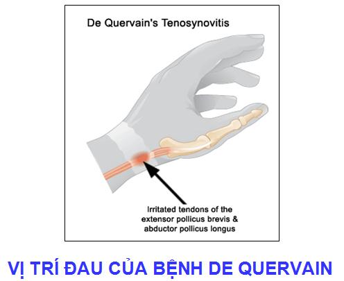 Cách điều trị viêm bao gân cổ tay như thế nào