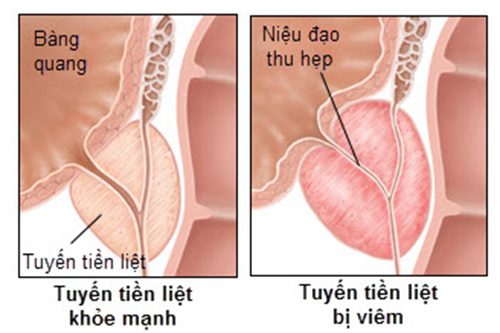 Cách điều trị viêm tuyến tiền liệt như thế nào