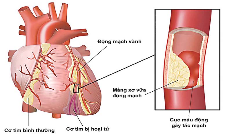 Cách điều trị xơ vữa mạch vành an toàn hiệu quả