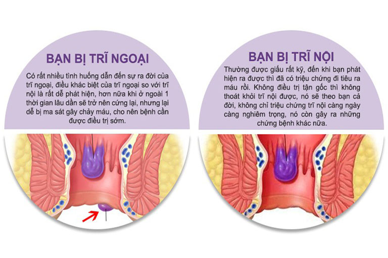 Cách phân biệt trĩ nội và trĩ ngoại như thế nào