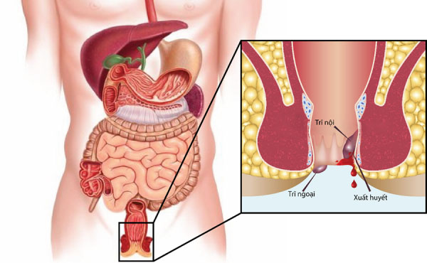 Cách phân biệt trĩ nội và trĩ ngoại như thế nào