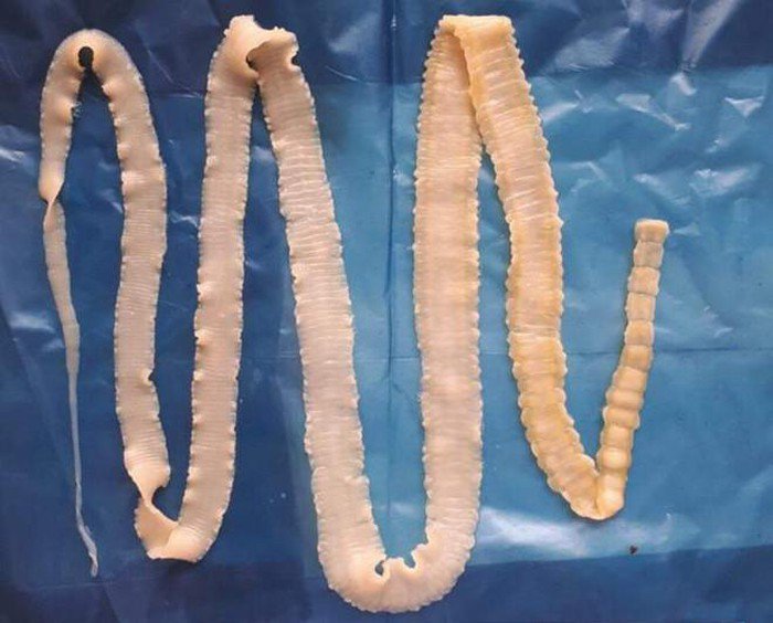 Cách phòng ngừa bệnh sán lợn ở người