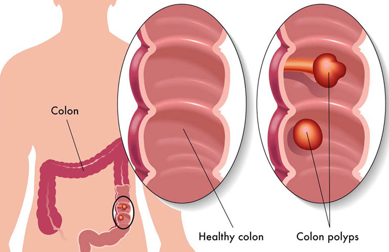 Cách phòng ngừa ung thư ruột già như thế nào