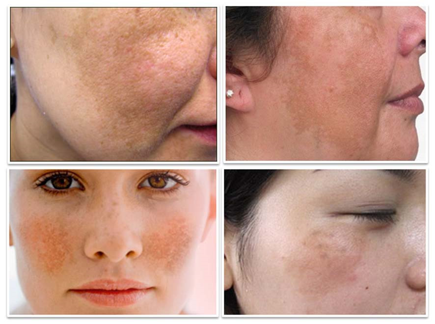 Cách trị nám da mặt lâu năm an toàn hiệu quả