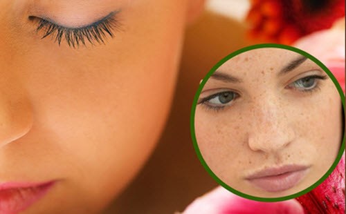 Cách trị nám tàn nhang an toàn hiệu quả