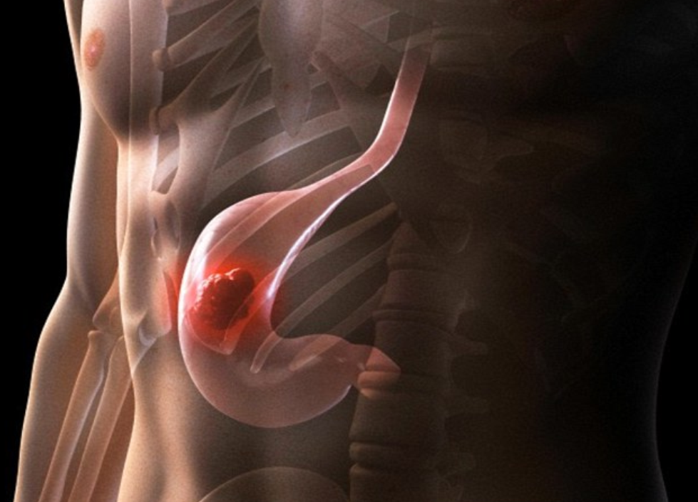 Chữa ung thư dạ dày giai đoạn cuối như thế nào