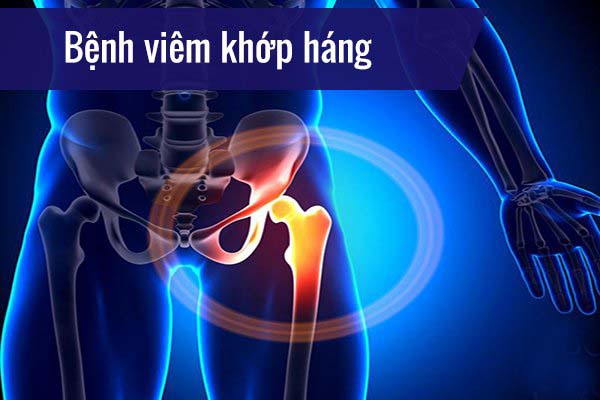 Chữa viêm đa khớp bằng đông y an toàn hiệu quả