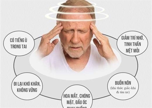 Dấu hiệu của tai biến mạch máu não và cách xử lý nhanh