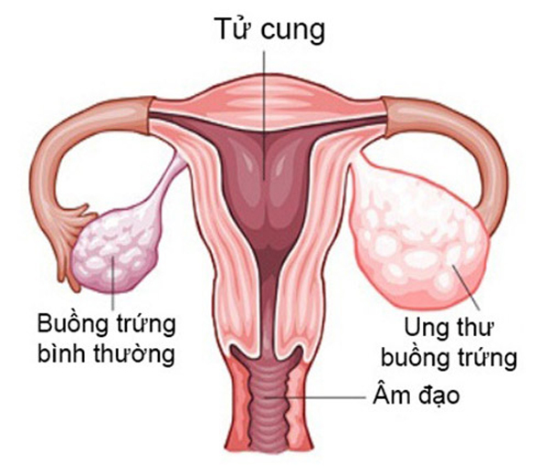 Dấu hiệu ung thư tử cung buồng trứng là gì và cách phòng bệnh ra sao