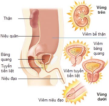 Dấu hiệu viêm đường tiết niệu là gì và cách điều trị bệnh ra sao
