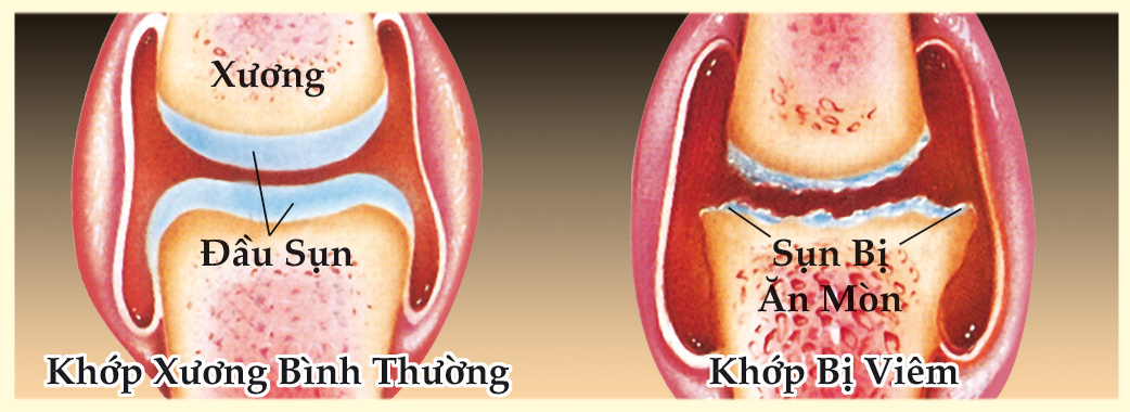 viêm xương khớp