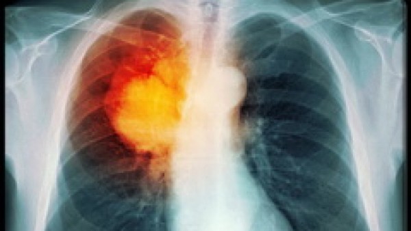 Diễn biến ung thư phổi giai đoạn cuối như thế nào