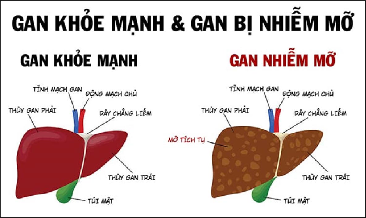 Cách chữa bệnh gan nhiễm mỡ không do rượu