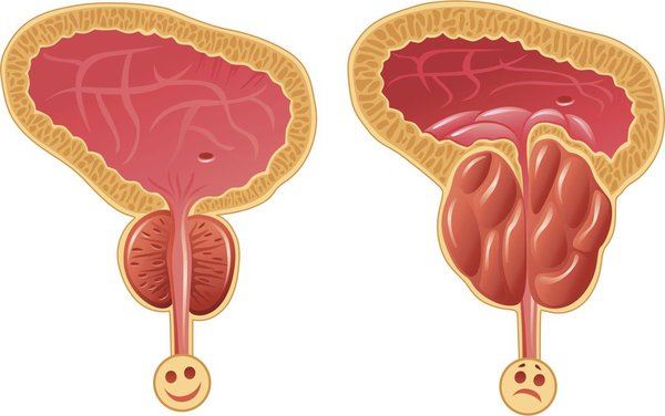 Kích thước phì đại tiền liệt tuyến như thế nào