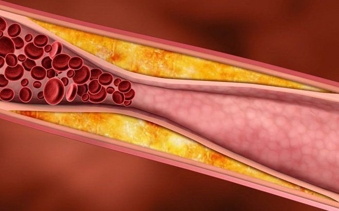Mảng xơ vữa thường gặp ở đâu