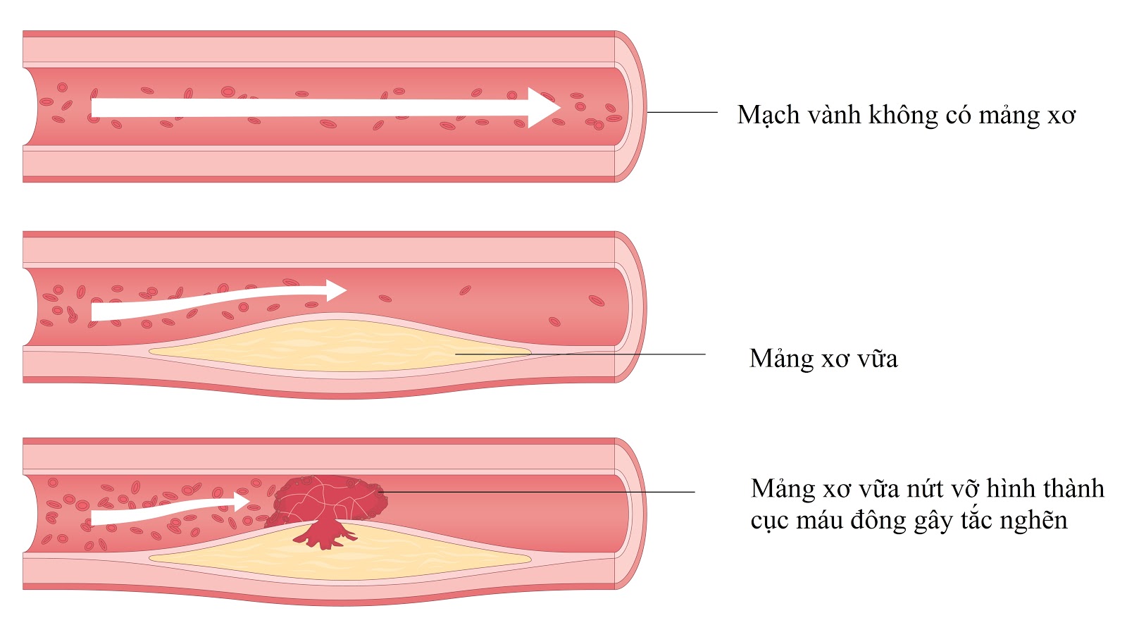 Mảng xơ vữa thường gặp ở đâu