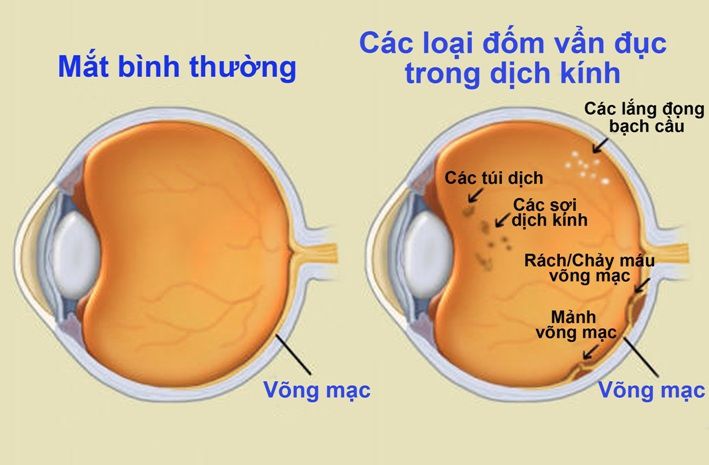 Mắt bị mờ phải làm sao để sáng hơn