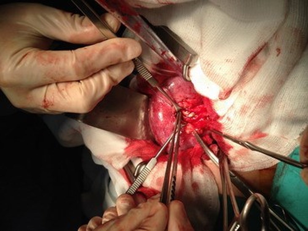 Mổ sỏi thận có nguy hiểm không và nên mổ ở đâu tốt