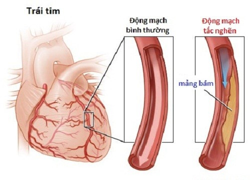 Ngăn chặn nguy cơ nhồi máu cơ tim và tai biến mạch máu não 