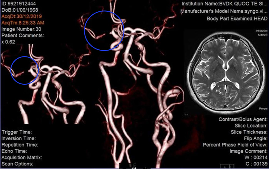 Nguyên nhân bệnh dị dạng mạch máu não