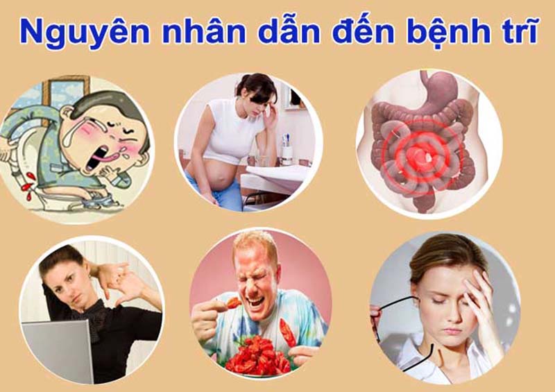 Nguyên nhân của bệnh trĩ và cách điều trị hiệu quả