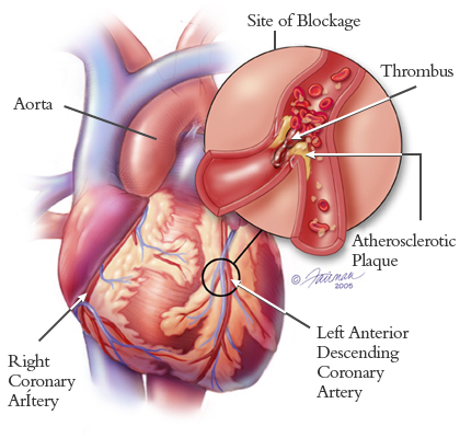 Nguyên nhân của nhồi máu cơ tim là gì và cách phòng bệnh ra sao
