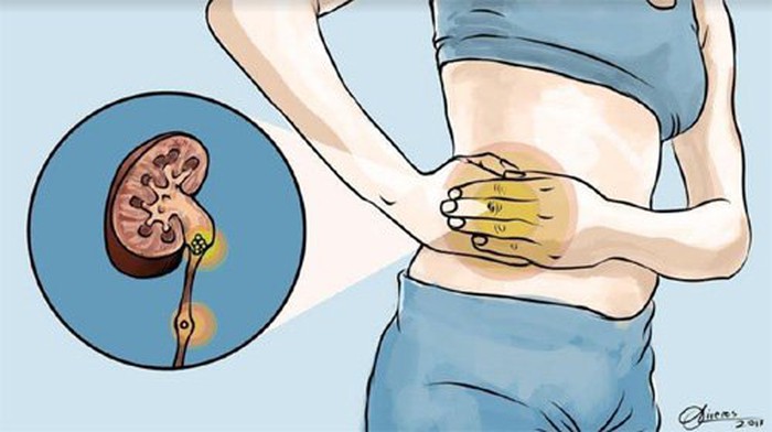 Nguyên nhân gây ra sỏi thận