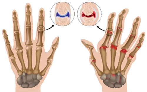 đau khớp ngón tay