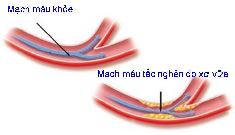 Nguyên nhân xơ vữa mạch máu