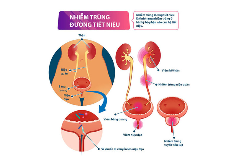 Nhiễm trùng đường tiết niệu ở nữ phải làm sao