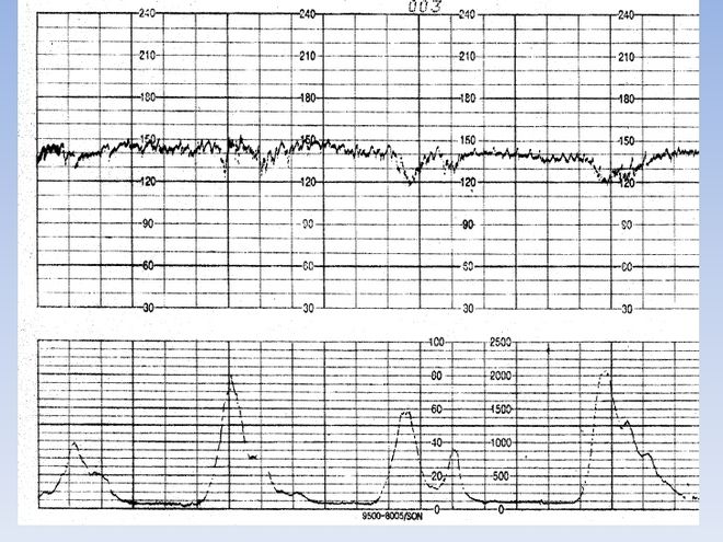 Nhịp tim bình thường của thai nhi là bao nhiêu