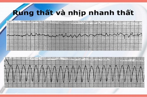 Nhịp tim đập nhanh là bệnh gì và cách khắc phục ra sao