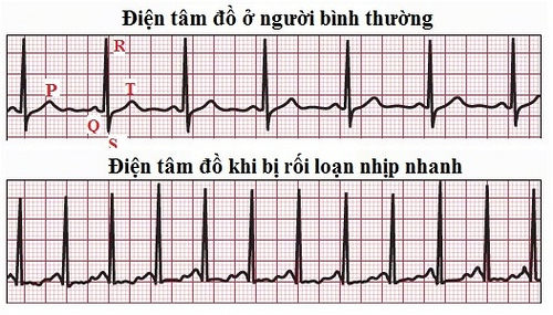 Nhịp tim nhanh và cách điều trị an toàn hiệu quả