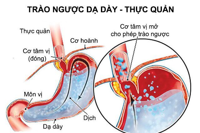 Nhịp tim nhanh và cách điều trị an toàn hiệu quả