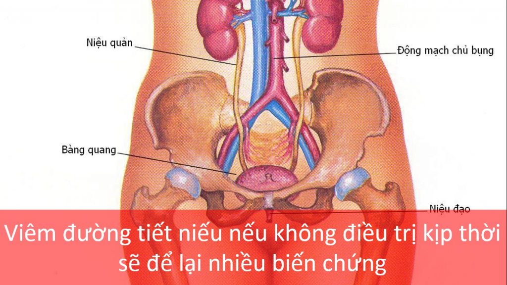 Phác đồ điều trị viêm đường tiết niệu như thế nào